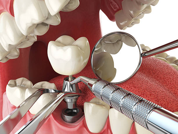 Best Emergency Dentist for Lost Fillings or Crowns in North Zanesville, OH